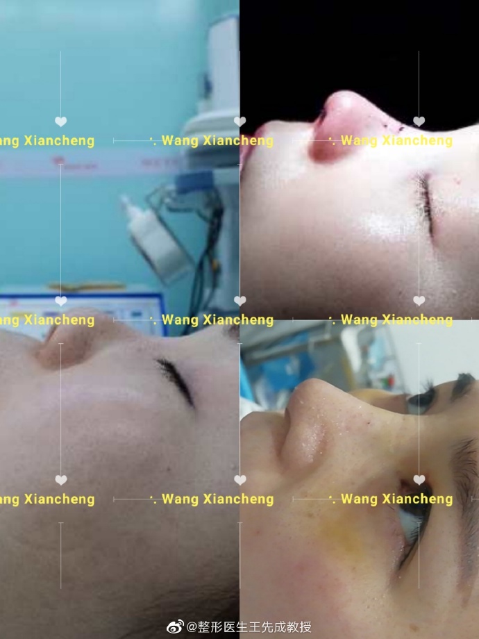 王先成鼻综合效果好吗？找他做鼻修复的人多吗