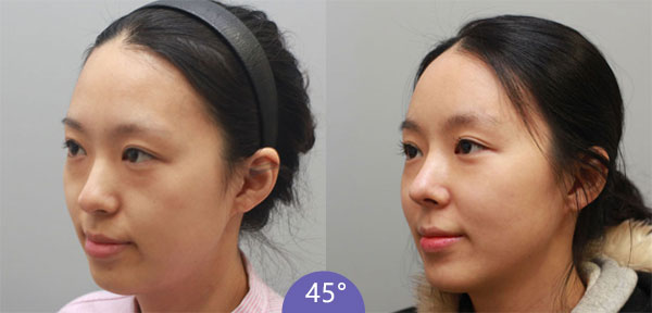 上海美莱卢建做鼻子怎么样？技术靠谱吗？