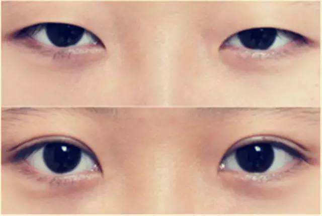 乌鲁木齐张伟双眼皮做的怎么样