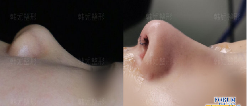 牟北平和沈绍勇哪个隆鼻技术好