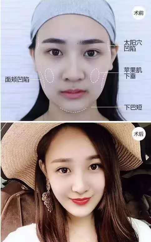 上海九院自体脂肪填充哪个医生做的好