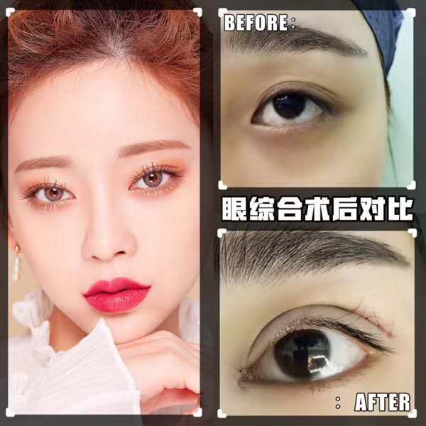 杭州双眼皮医生哪个好？