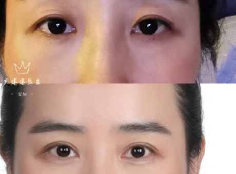 北京八大处医院哪个医生做双眼皮好