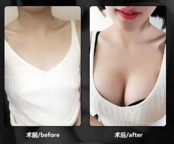 北京做自体脂肪丰胸效果好的医生是谁？