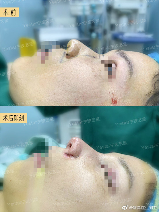 宁波刘卫和孙明磊哪位医生鼻子做的好