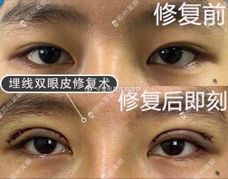 郑州眼修复田国静和杨丽哪个专业