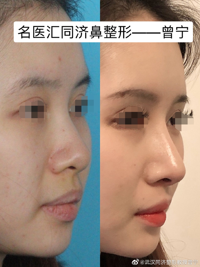 武汉曾宁和邓裴谁做鼻修复好