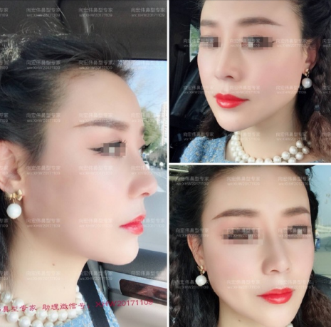 深圳向宏伟鼻子做得怎么样