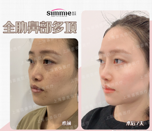 上海做鼻子好的医生有哪些