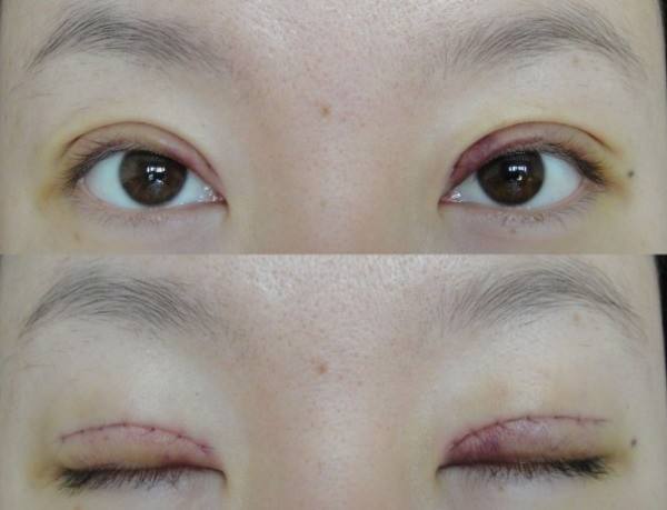 北京双眼皮哪里做的比较好