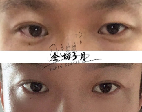 北京八大处卢建建和王太玲谁做双眼皮好