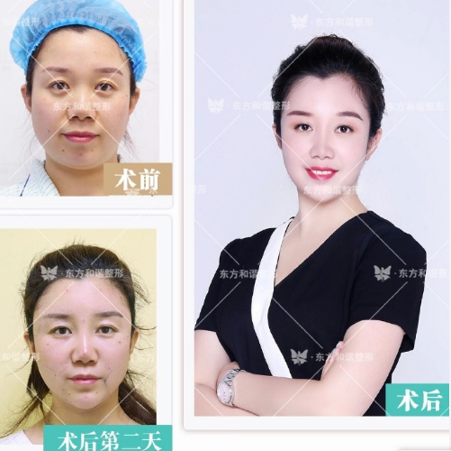 王自谦和王明利哪个脂肪填充好些