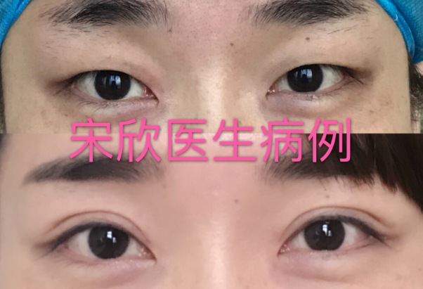 上海九院宋欣做双眼皮怎么样