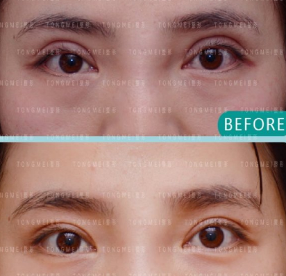 北京做双眼皮修复最好的医生是哪个