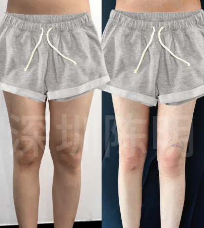 长沙吸脂陈仕文和邓旭辉哪个医生做吸脂技术好？