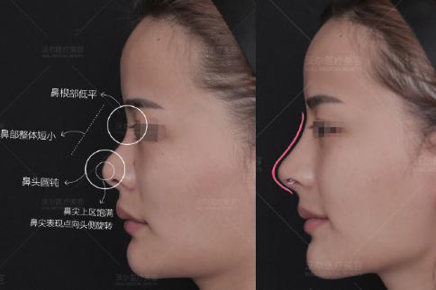 国内全肋隆鼻修复医生哪个最好