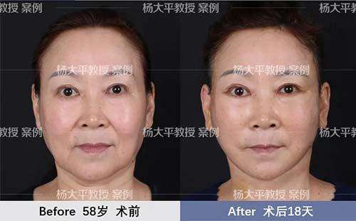 北京面部提升哪个医生技术好