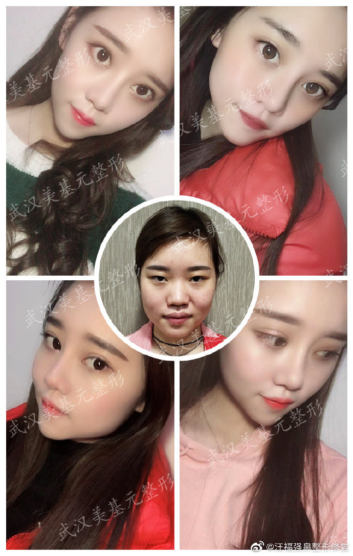 汪福强做鼻修复技术怎么样？