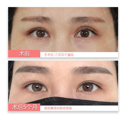 沈阳哪个整形医生双眼皮修复做得好