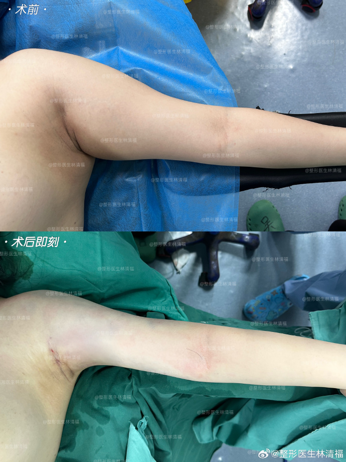 厦门吸脂谁最好？林清福和王阳明哪个医生吸脂好？