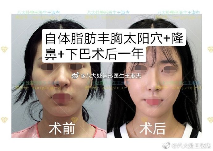 八大处哪个医生做脂肪填充比较好