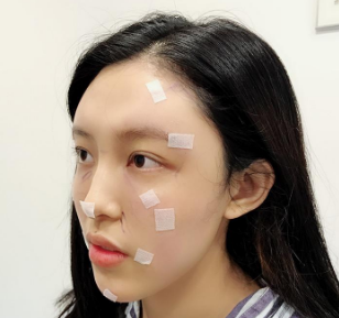 全脸脂肪填充成都哪位医生做的好