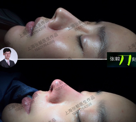 上海张毅和杨凌飞谁鼻子做得好