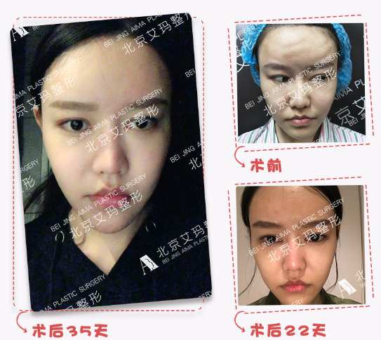 北京哪个医生做脂肪修复好