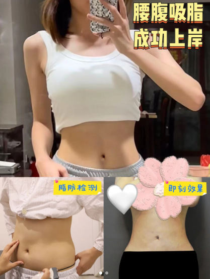 2026年成都吸专家赵善军、郑方荣、王欣、李祥彬、赵善军谁做吸脂做得最好？