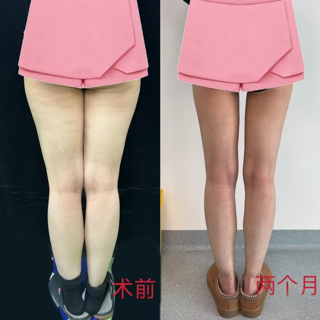 北京八大处吸脂技术最好的医生吕倩雯、杨增杰、陈博、王维新、李发成、顾云鹏谁更厉害？