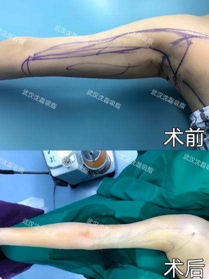 武汉吸脂哪个医生技术最好？朱继锋、陈克、沈磊、包涛、杨杰做吸脂谁口碑最好？