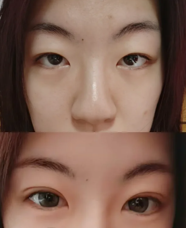 北京做双眼皮专家八大处林琳和卢建建哪个医生割双眼皮好？