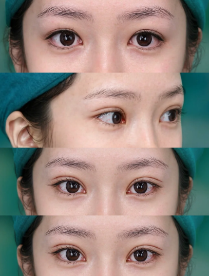 上海双眼皮修复医生马娟和郑小红谁做双眼皮修复好？