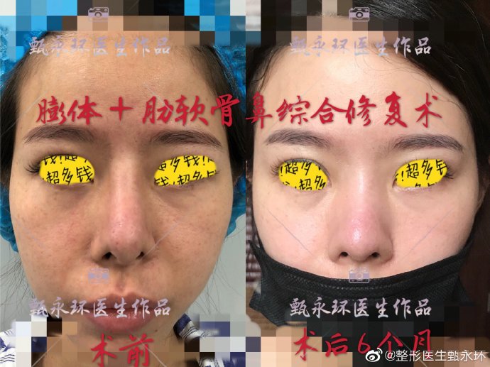 甄永环做鼻综合效果好不好？这个医生知名吗？