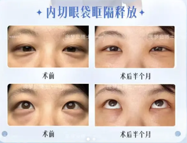 贵阳做祛眼袋专家庞梦茹和安宁哪个祛眼袋技术好？