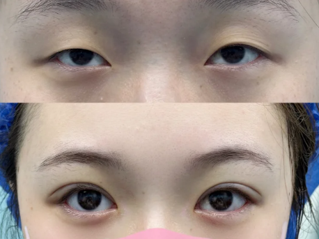 长沙双眼皮邹俊峰和罗亮哪个医生做双眼皮技术好？邹俊峰和罗亮预约咨询电话