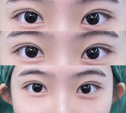 北京胡彬和吴焱秋哪个医生割双眼皮技术好？胡彬和吴焱秋双眼皮预约电话