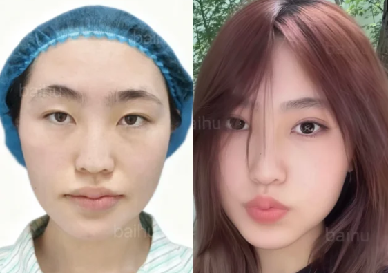 呼和浩特双眼皮医生推荐哪个？白虎和裴大伟割双眼皮技术谁厉害？