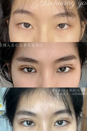 温州做双眼皮专家黄亚奔、应胡足和李力群哪个医生割双眼皮技术好？