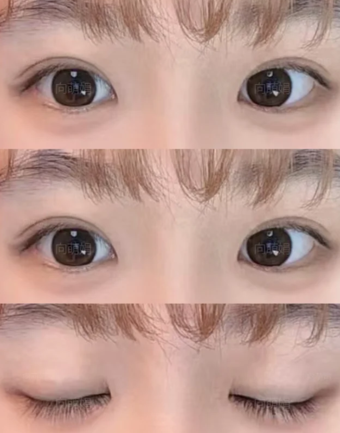 深圳双眼皮修复专家向萌娟和王志东哪个医生眼修复技术好？向萌娟和王志东预约咨询电话