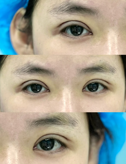 台州做双眼皮专家成浩和郑金满哪个医生割双眼皮好？