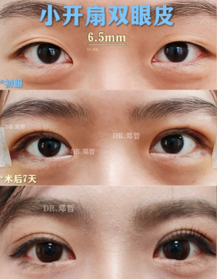 苏州邓哲和谢晓明哪个医生做双眼皮口碑好？邓哲和谢晓明预约咨询电话