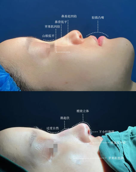北京八大处张旭龙做隆鼻怎么样？八大处张旭龙隆鼻怎么预约？