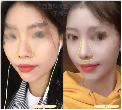南宁隆鼻于海生和刘泳铖哪个医生技术好？于海生和刘泳铖隆鼻预约咨询电话