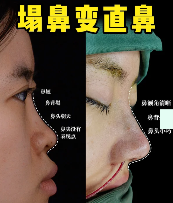 合肥隆鼻医生赵士俊和孙洋哪个技术好？赵士俊和孙洋做鼻子谁口碑更好？
