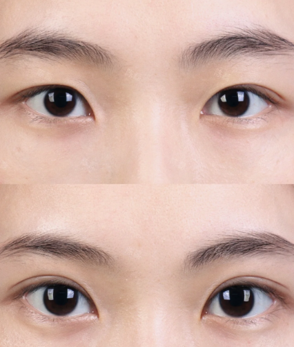 大连王洁晴和李研哪个医生做双眼皮好？王洁晴李研做双眼皮在线咨询预约