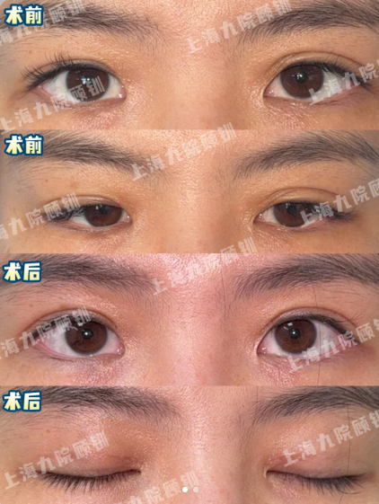 上海九院双眼皮修复医生哪个好？顾钏、金锐、周显玉、王俊芳、马昊眼修复谁更厉害？