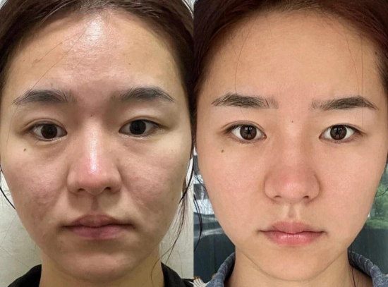 北京面部提升专家王春虎和谢洋春哪个医生做拉皮好？