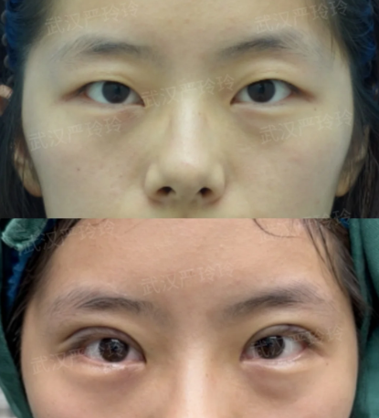 武汉双眼皮严玲玲和曹玮哪个医生技术好？严玲玲和曹玮预约咨询电话