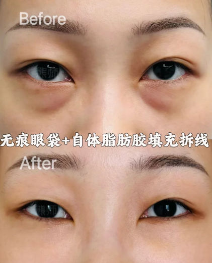 宁波做祛眼袋专家熊师和陆欣谁更好？熊师陆欣祛眼袋口碑预约咨询电话